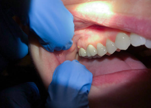 Best Emergency Denture Repair in Aransas Pass, TX